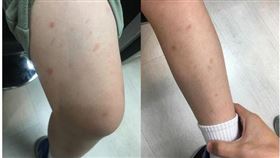 若家中孩童突冒紅疹，恐過敏性紫斑症所致。（圖／書田診所提供）