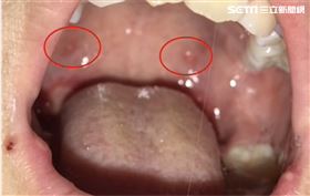 爸爸親一個！一歲大雙胞胎兒竟嘴全爛（圖／醫師提供）