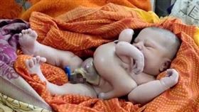 印度畸形兒