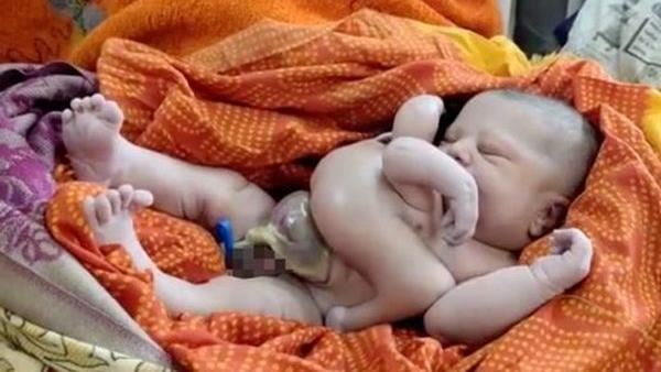 孕婦誕4手4腿嬰兒！民眾跪地膜拜
