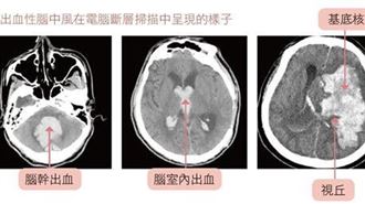 納豆腦出血手術！醫曝這5種人危險　