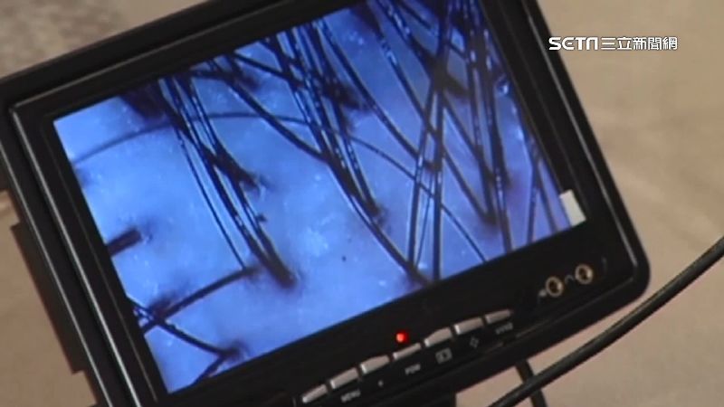 打完BNT11天　男後腦「圓形禿」
