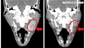 澄清醫院中港院區，48歲婦人左頸腫塊越長越大，左側扁桃腺癌第三期 (圖／澄清醫院中港院區提供)