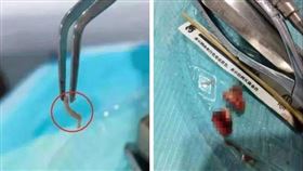 男子蛀牙中有蛆。（圖／翻攝自廣州日報）