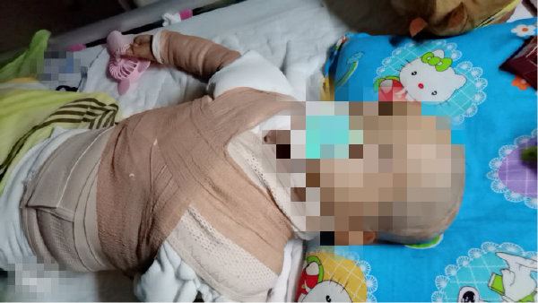 3歲童跌進油鍋…全身炸爛剩五官完好