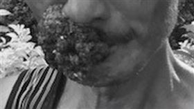 口腔癌 唇癌 魏林瑰醫師(台北慈濟提供)