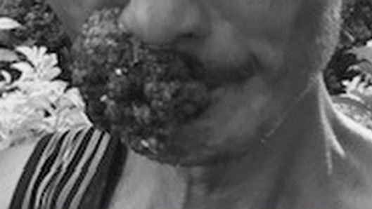 唇癌惡化成口腔癌末期　腫瘤吃臉外露