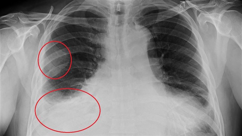死亡率比肺炎高　有5症狀恐「膿胸」