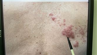 溫差大免疫力崩!引發帶狀疱疹恐面目全非