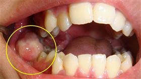 智齒發炎竟釀「口腔癌第四期」　18歲男靠大手術保命 (台北慈濟醫院提供)