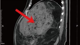 經腹部電腦斷層影像發現，楊先生的腫瘤巨大，連脊椎都受到壓迫。（圖／馬偕醫院提供）