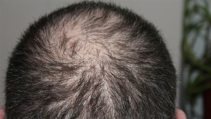 頭髮稀疏、皮膚發炎　竟是缺乏「它」