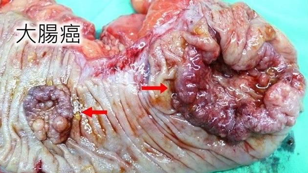 迎戰晚期大腸癌　基因檢測找最佳武器