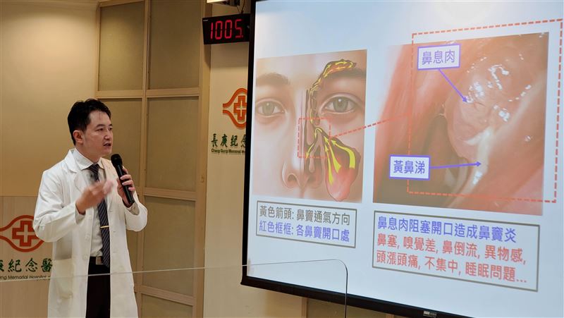 妙齡女鼻塞、咳黃痰　竟是重度鼻竇炎