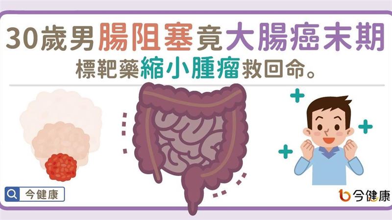 大腸癌末期還有救？　醫：情況分三類