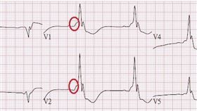 ▲心電圖有斜向電波(圈圈處)，表示心臟電氣會提早從額外的電線傳遞到心室。（圖／台北慈濟醫院提供） 