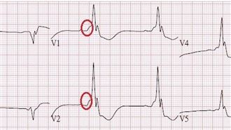心臟竟多一條電線？壯男猝死搶救重生