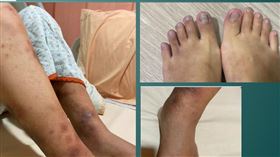 台中榮總，女工程師，高安氏動脈炎，雙腳紫斑潰爛，呼吸困難。(圖／台中榮總提供)