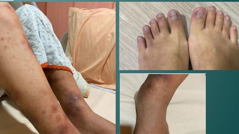 妙齡女莫名腳腫變黑　救醫已心肺衰竭