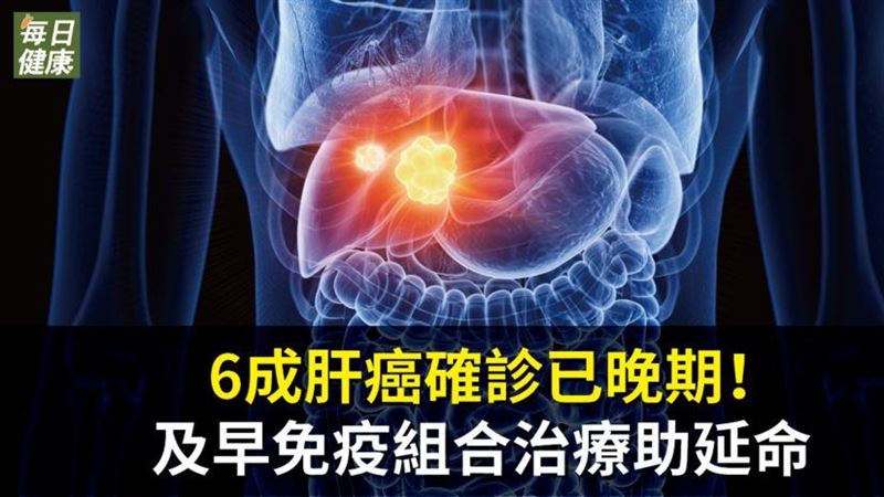 6成肝癌確診已晚期　組合治療助延命