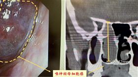 嗅神經母細胞癌,鼻腔,,檢查（圖／中醫大新竹附醫提供）