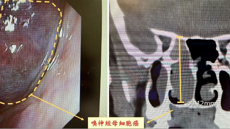 新竹男流血絲鼻涕　竟罹罕見母細胞癌