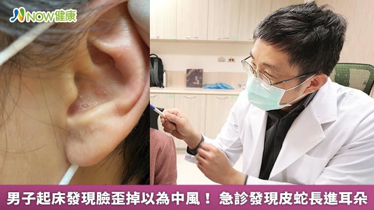 臉歪掉以為中風！ 急診發現皮蛇長耳