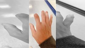  3隻手指遭截肢，工傷，職災，遭公司主管嗆，「你那樣嚴重嗎？還好吧！」(圖/翻攝自爆料公社)