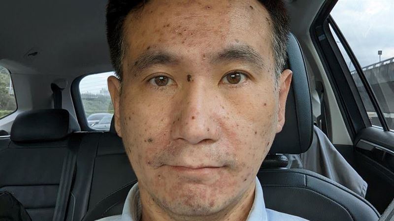 嚇！鄭運鵬驚人水痘　醫揭最嚴重位置