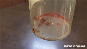 腎結石(讀者提供)