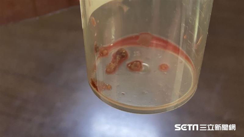 尿路結石5成會復發　醫：少吃這食物