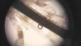 蟎蟲患者的睫毛根部有許多黏稠的的白屑屑。(台北慈濟提供)