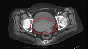 不明血尿「不會痛更可怕」　醫師：恐是泌尿道癌症(台中醫院提供)