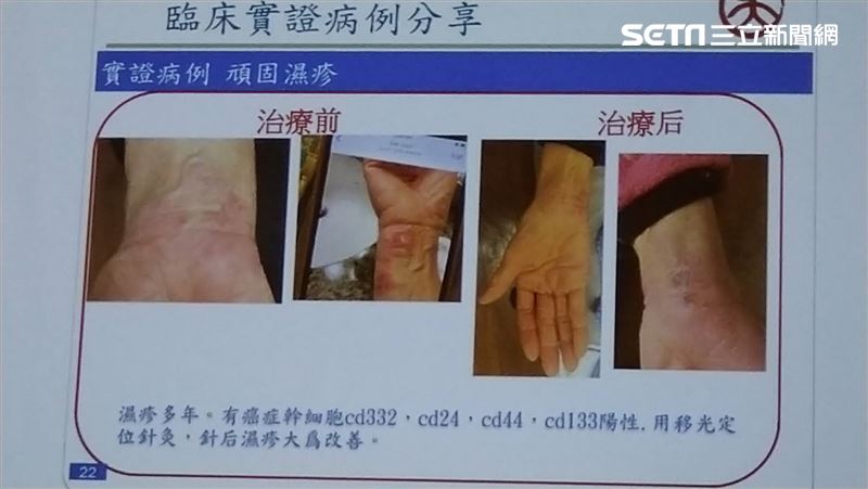 乾癬原因揭曉！針灸展現強大效果