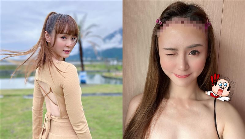 女神頭扎3000根植髮　術後照曝光