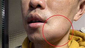 蜂窩性組織炎(南投醫院提供)