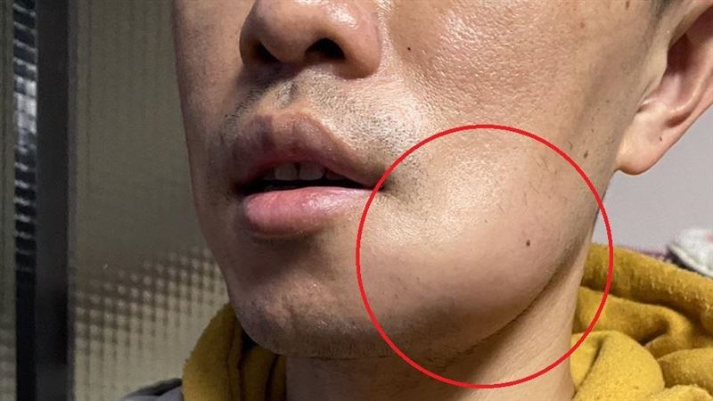牙痛不恐怖？細菌從牙齦吃進他的脖子