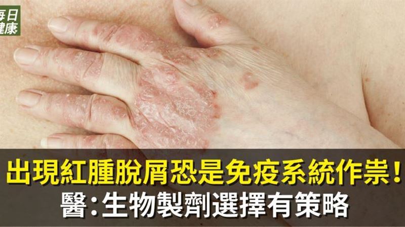 皮膚、指甲脫皮紅腫恐是免疫系統作祟