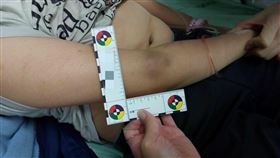 謝宗學醫師說，比較值得注意的是，平常比較不容易碰撞到的手肘內側和軀幹胸部也出現瘀青。（圖／翻攝自Dr. E 小兒急診室日誌）