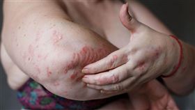 中醫,袁國山,皮膚癢,乾癬,跨年,皮膚科
圖／袁國山中醫師提供