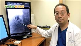 高雄長庚醫院放射診斷科余俊彥醫師表示，透過肝動脈碘油化療栓塞降期治療，有助提升肝癌治療效果。
