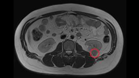 男大生得腎臟癌(台中醫院提供)