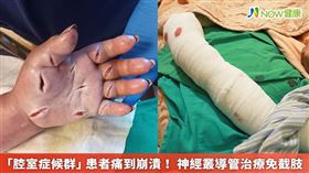 名家專用／70歲婦罹患「腔室症候群」，雖經緊急手術後保住手臂，但術後極度疼痛，必須施以特殊止痛處理。(勿用)