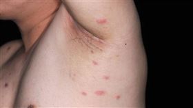 蟲蟲皮膚病（圖／皮膚科醫學會提供）
