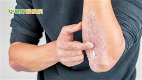 許多乾癬患者經常過度清潔或零清潔，但無論四季，只要水溫不要過高，患部都應適度清潔、保持乾淨的狀態，原則上以水溫不超過40度即可，因此冬季若患者想要也可以適當的泡澡、泡溫泉。