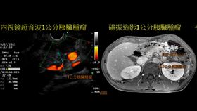 胰臟癌，腫瘤，2年輕男子罹癌王，醫師分析有5大共通點(圖／翻攝自胰臟醫師林相宏粉專)