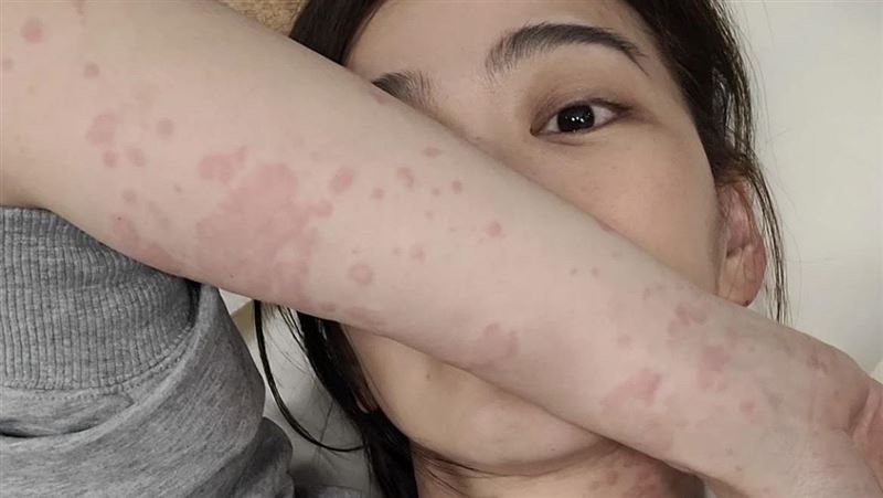 邵庭全身長滿紅斑急求醫　無奈遭反噬