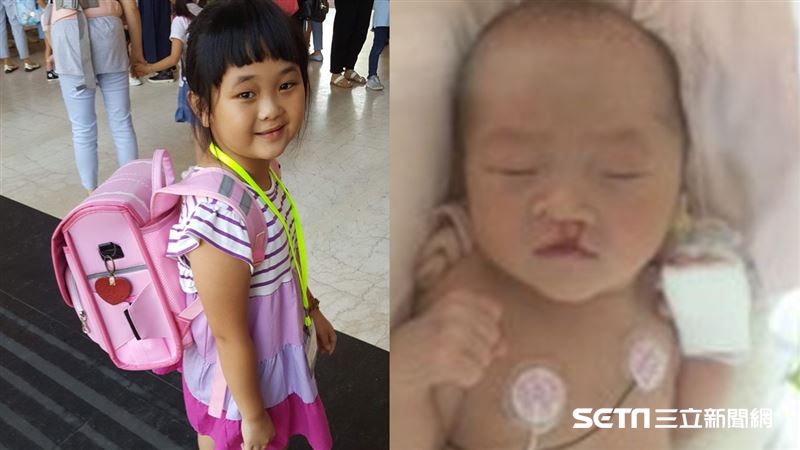 「你鼻子歪歪的？」唇腭裂童回應催淚