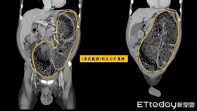 宿便,便秘,張巨成醫師,乙狀結腸（圖／中醫大新竹附醫提供）