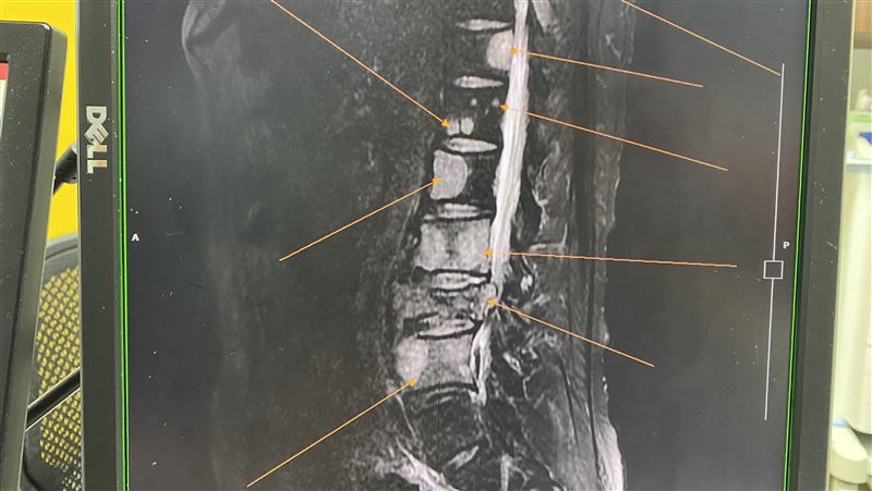 腰痛不是「閃到腰」　元凶竟是肺癌